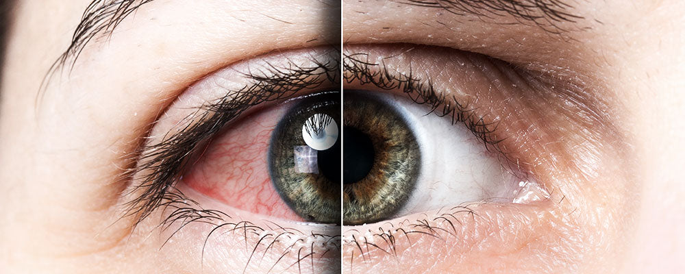 Síndrome del ojo seco – Ópticas LUX, Ve Más Allá